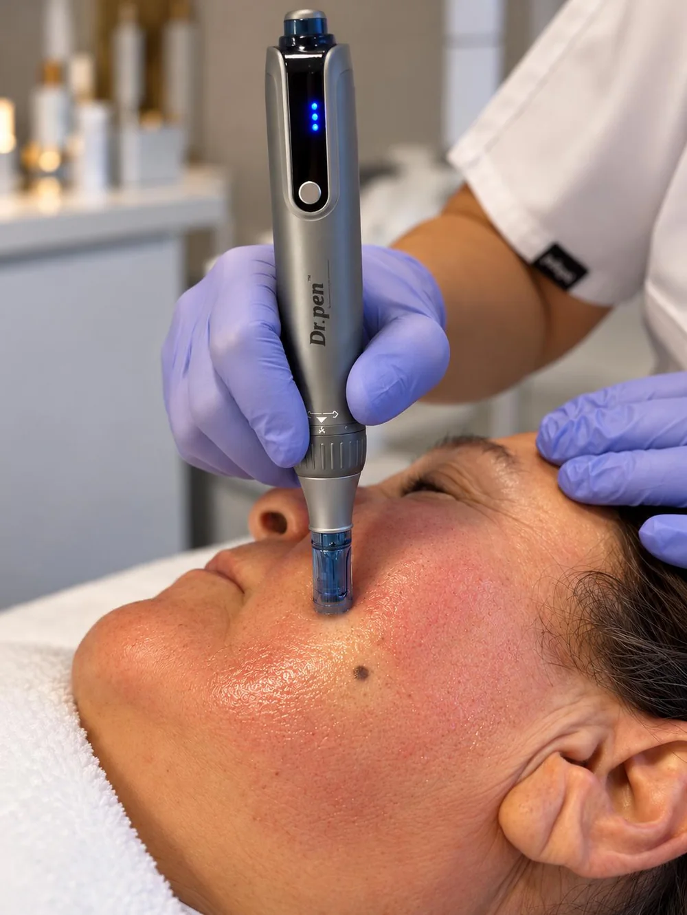 Microneedling-Behandlung im Gesicht mit einem Microneedling-Pen